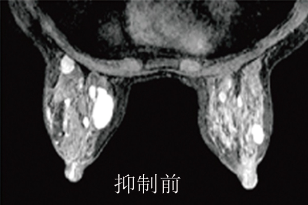 優(yōu)異的脂肪抑制技術(shù)